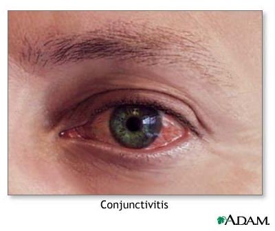 Learn about Allergic Conjunctivitis along with Its Causes and Treatments