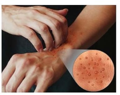 Using Natural Remedies for Eczema