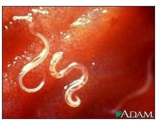 Intestinal Parasites in Humans: Symptoms & Herbal Remedies