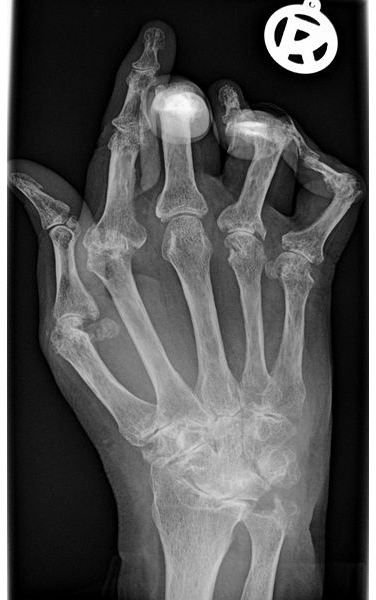 X-Ray Rheumatoid Arthritis