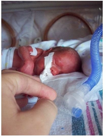 Premature Infant (26 weeks 6 days gestation)