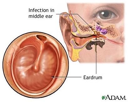 Home Remedies for Ear Infections: Self Care & Home Treatment
