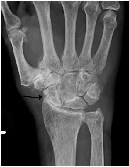 Severe osteoarthritis and osteopenia of the carpal joint and 1st carpometacarpal joint.