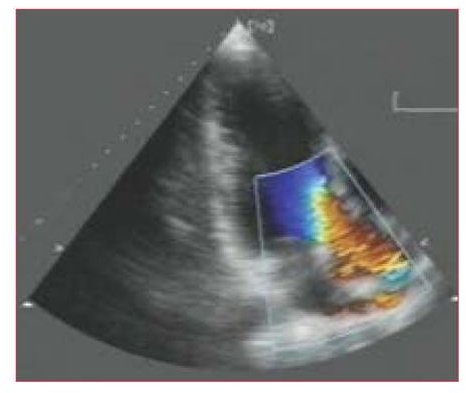 Color-flow mapping in an echocardiogram