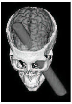 Impulsivity Dopamine Treatment:  Understanding Dopamine as a Cause and Treatment of ADHD Impulsivity