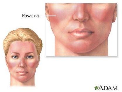 All Natural Treatments for Rosacea