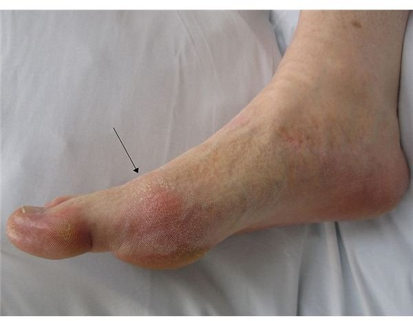 How Does Colchicine Gout Treatment Works?