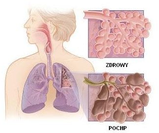Symptoms of Chronic Obstuctive Pulmonary Disorder ( COPD ) or Chronic Bronchitis