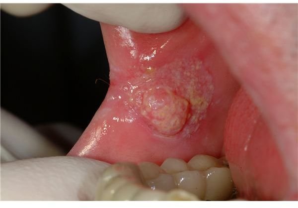 What Does Oral Cancer Look Like in the Mouth or Cheek?