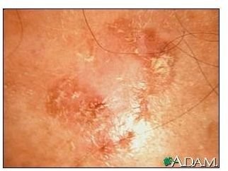 Learn about Drug Treatments for Squamous Cell Skin Cancer