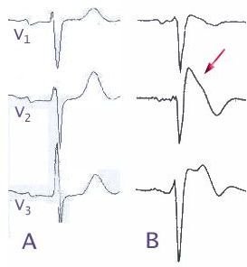 Brugada Syndrome and Brugada Symptoms