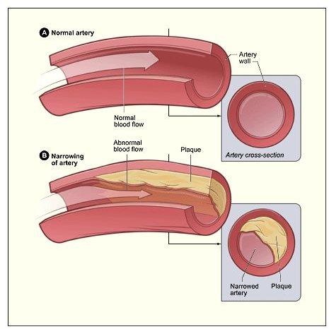 What Are the Causes of Atherosclerosis?