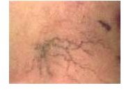 Causes of Spider Veins