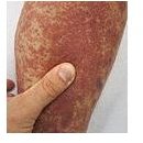 Lymphocytic Vasculitis Skin Rash: Why Does it Occur and How Can you Prevent It?