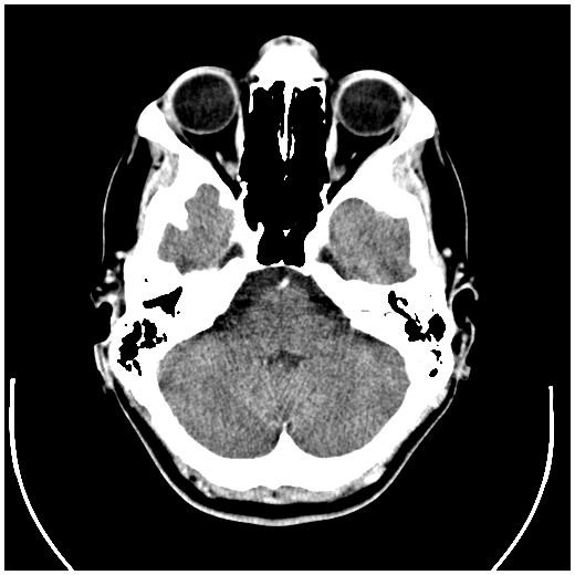 CT Scans increase Cancer Risk