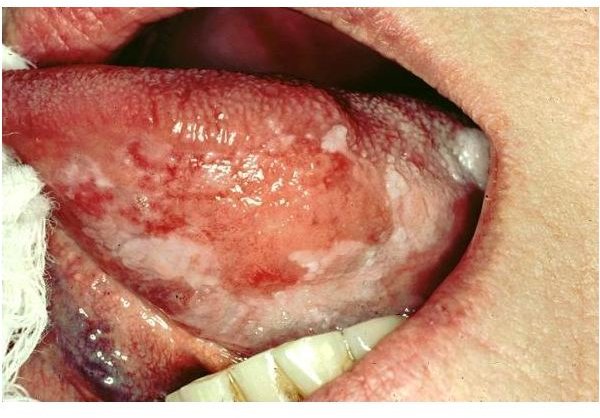 What Does Tongue Cancer Look Like? Discover the Visible Symptoms of Tongue Cancer in Adults