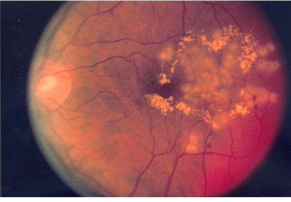 showing focal laser surgery for diabetic retinopathy