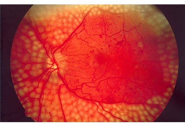All About Diabetic Retinopathy Treatment