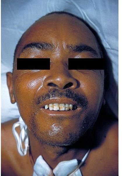 Lock-jaw in a patient suffering tetanus.