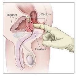 There are New Treatments for Impotence Caused by Prostate Cancer