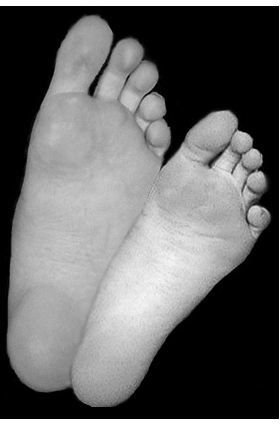 Find Home Remedies for Common Foot Problems