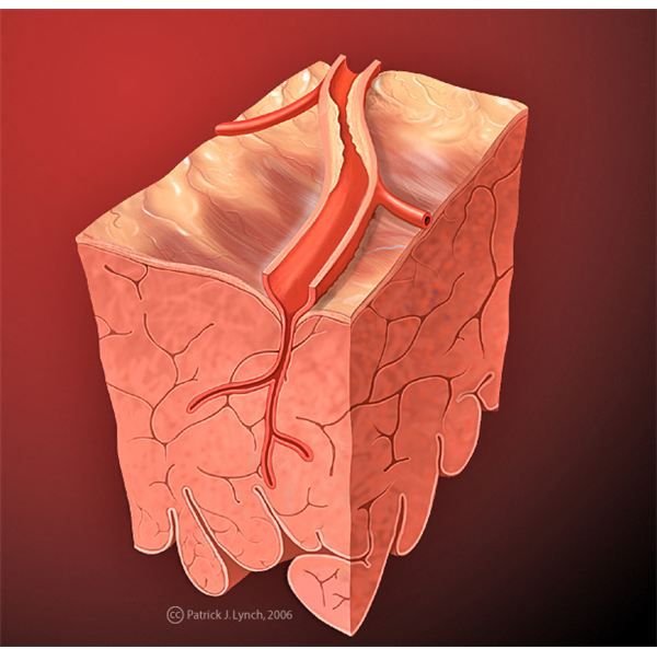 Coronary Artery Disease Pathophysiology