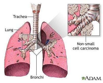 Learn to Identify Lung Cancer Warning Signs