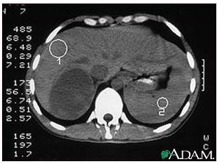 Learn about Tests for Adrenocortical Carcinoma