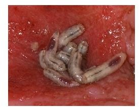 Maggot Therapy for Non-Healing Wounds