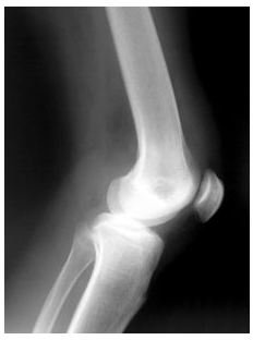 Knee X-Ray