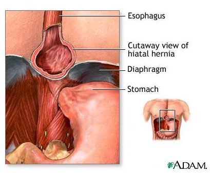 What Is a Hiatal Hernia?