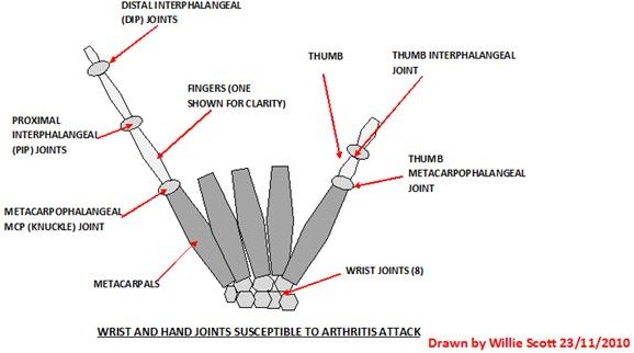 Pain Relief for Hand Arthritis