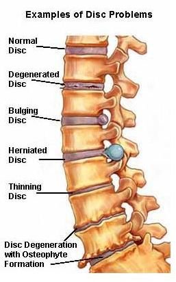 Lumbar Laminectomy Overview