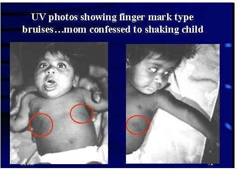 UV image of bruises of a child - photo courtesy of Detective Patrick Cochran, Austin Police Department