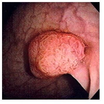 Gardner Syndrome Genetics and Gardner Syndrome History