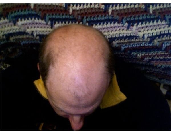 Possible Baldness Gene Discovered and How it Could Lead to New Baldness Cures