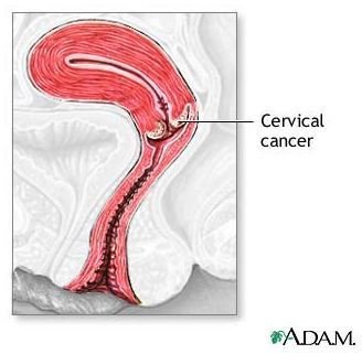 Cancer Cervical Radiation Therapy