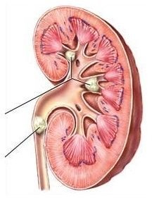 Kidney Stone Prevention: Learn the Causes of Kidney Stones and How to Prevent Them