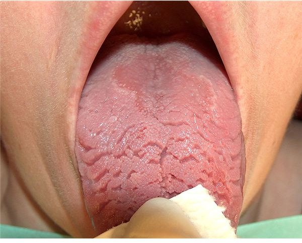 Remedies for Tongue Fissures