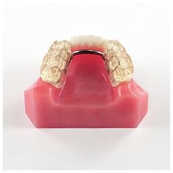 Different Splints Used to Treat TMJ