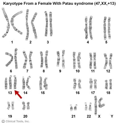 The Killer Karyotype of Patau Syndrome: What's So Unlucky About Trisomy 13?
