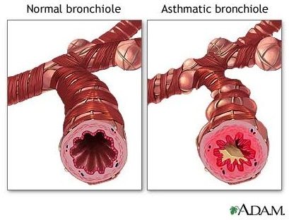 Asthma in Children: Find Natural Remedies for Asthma