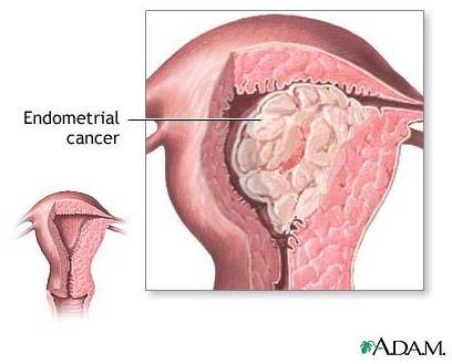 How is an Ultrasound Diagnosis of Endometrial Cancer Performed?