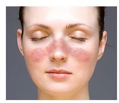 Lupus Butterfly Rash: Why do Patients with Lupus Develop Facial Rashes & How to Treat Them