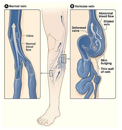 Are Varicose Veins Dangerous to an Individual’s Health?