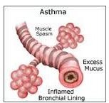 asthma