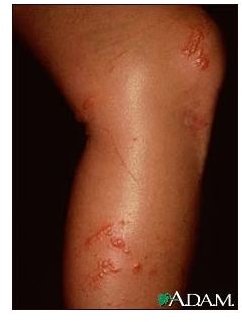 Poison Ivy Rash - Image courtesy of the National Library of Medicine (NLM)
