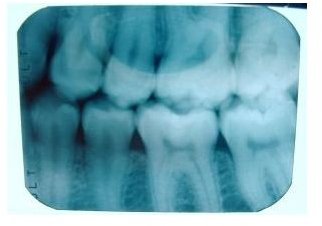 Teeth X-Rays Can Be Very Expensive