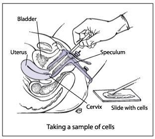 How is a Pap Smear Done?
