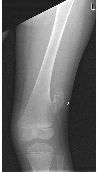 How to Test for Osteochondroma